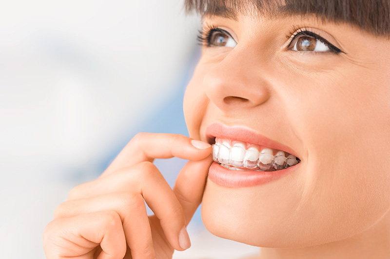 Spark Clear Aligners in San Gabriel