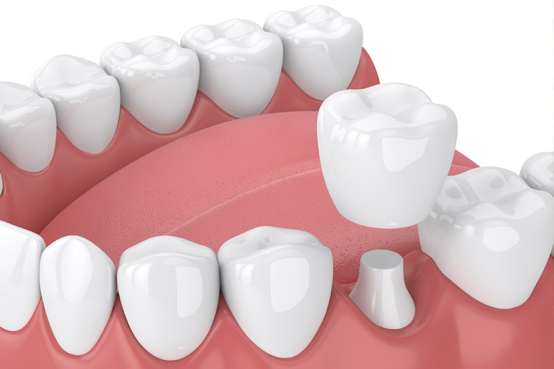 Dental Crowns in San Gabriel