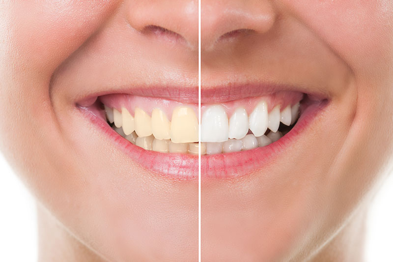 Teeth Whitening in San Gabriel