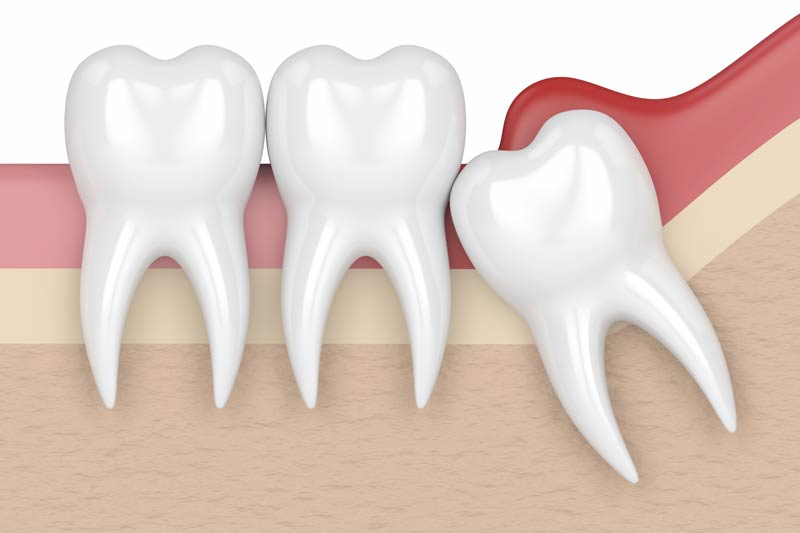 Wisdom Tooth Removal in San Gabriel